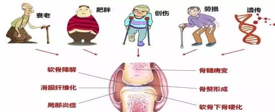 骨關(guān)節(jié)炎