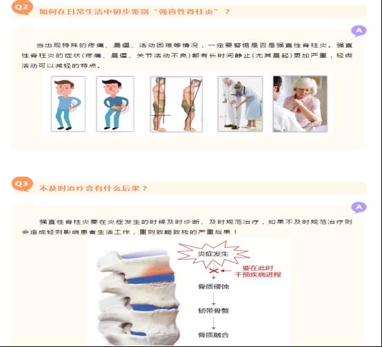 強直性脊柱炎